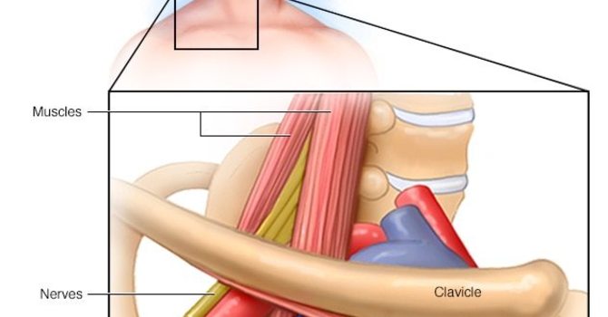 Chiropractic and Thoracic Outlet Syndrome image