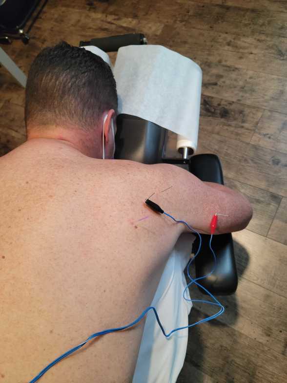 Dry Needling for neck pain