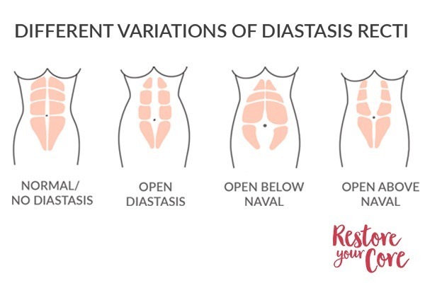 Dos And Donts Of Dra Diastasis Recti Abdominis Wurth Chiropractic